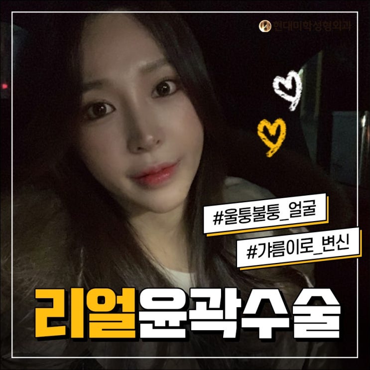 앞광대수술 실력 살아있네