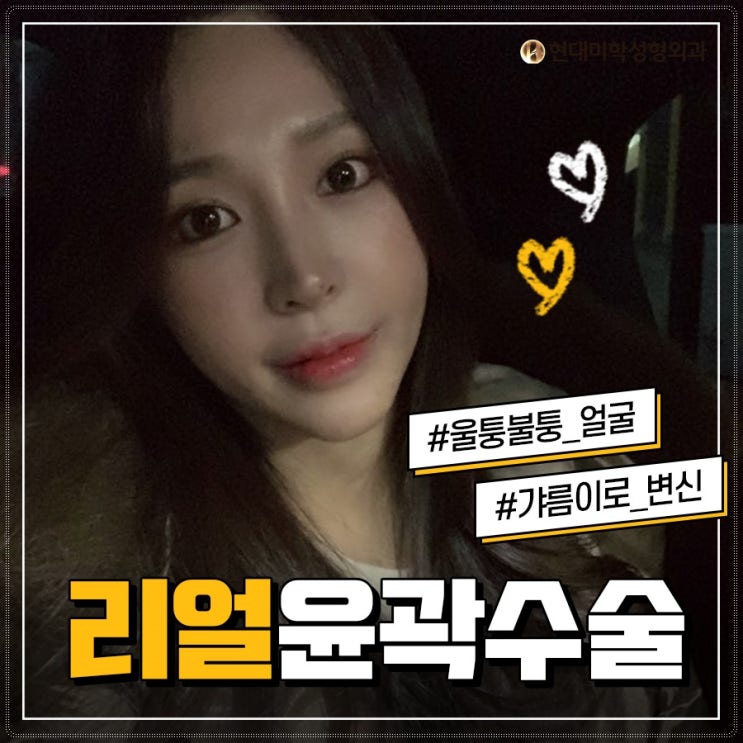 사각턱재건 다시 완성하다