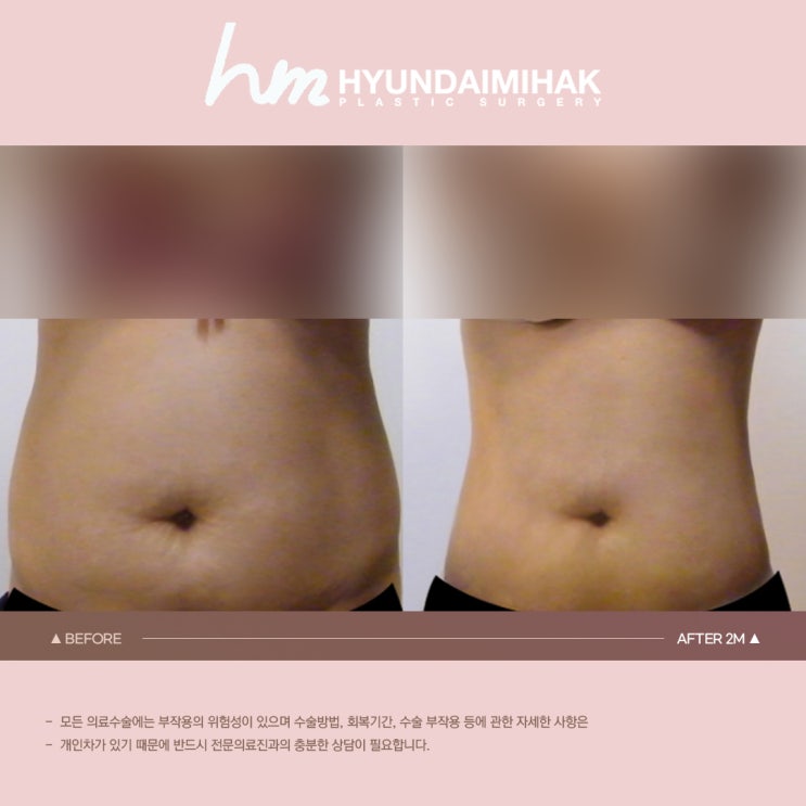 신사지방흡입 허벅지 안쪽살까지 정리하자