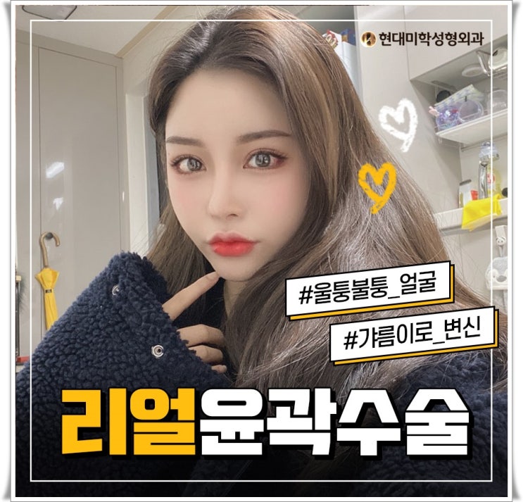 광대수술후기 미의 기준을 완성하다