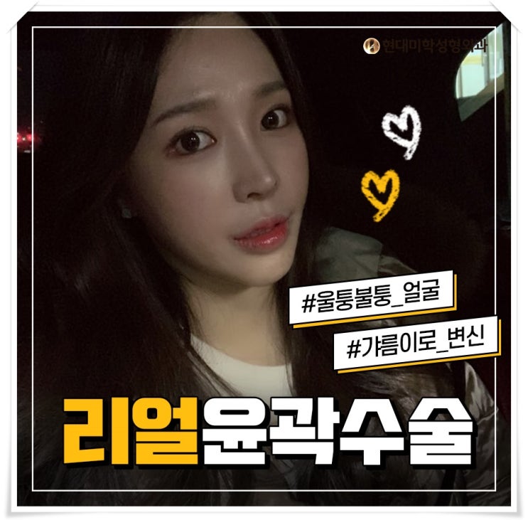 사각턱비용 와이거실화?