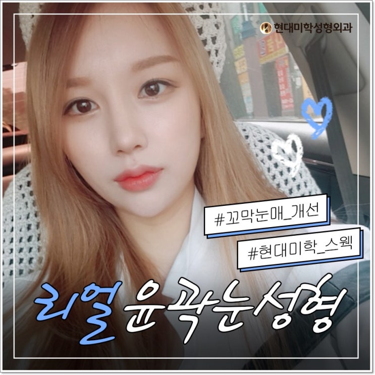 상안검 동안으로 변신