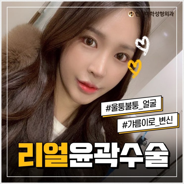 사각턱축소술 결과가 중요해
