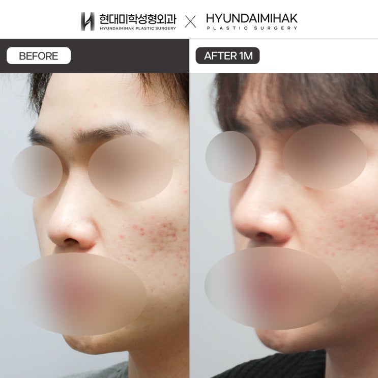 남성코수술 자연스럽게 성형하는 방법은