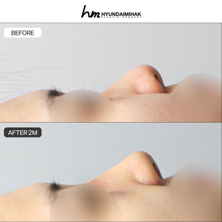 복코수술가격 부담은 줄이고 인상은 바꾸고