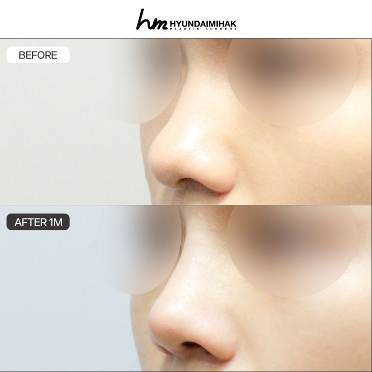 코수술잘하는곳 자연스럽고 만족스러운 변화의 시작