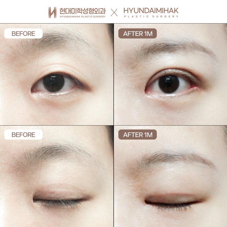 눈재수술잘하는병원 알아 볼 때 확인해야 할 것