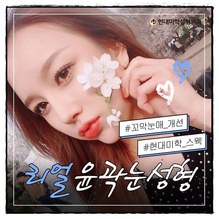 뒷밑트임후기 눈으로 확인해요
