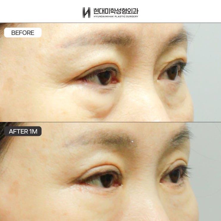 중년하안검성형 두둑한 눈밑 지방