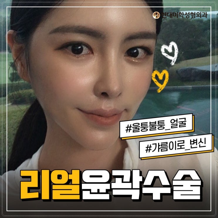 브이라인성형외과 갸름얼굴형