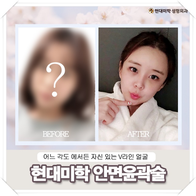 안면비대칭 자연스럽게 완성