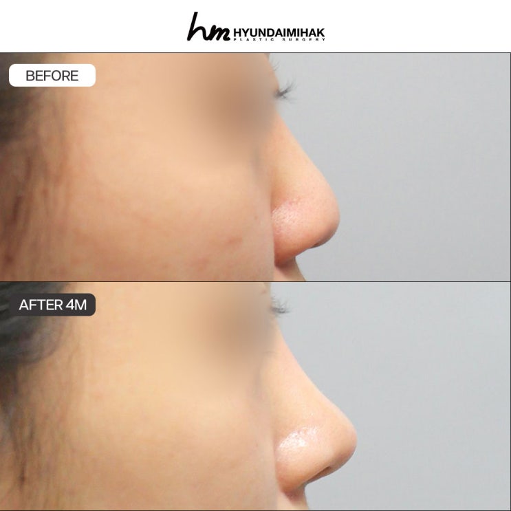 코라인종류 수술 전 필수 정보 확인하기