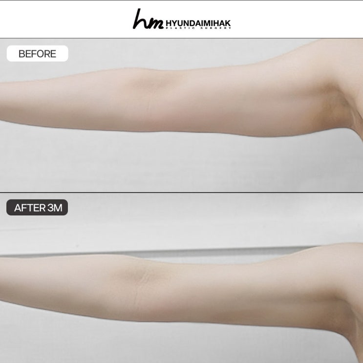 지방흡입전후 부위별 변화와 현실 후기｜진짜 얼마나 달라질까?