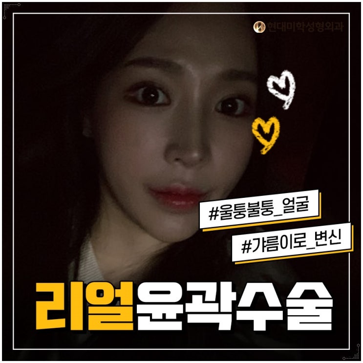 안면윤곽수술가격 아름다움의 근본
