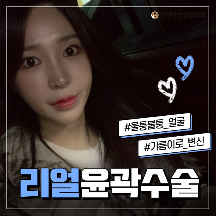 광대수술후기 예쁨이 뭍어있다