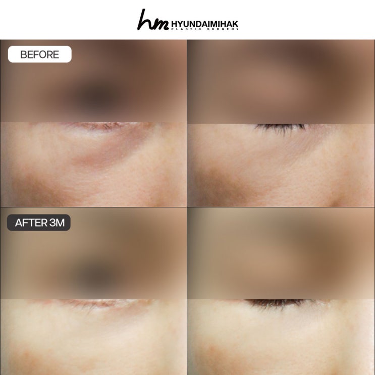 하안검비용 경험 많은 병원을 고르는 기준