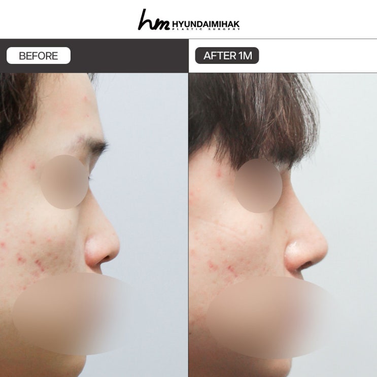 남자코수술 어떤 점이 다르고 어떻게 선택할까