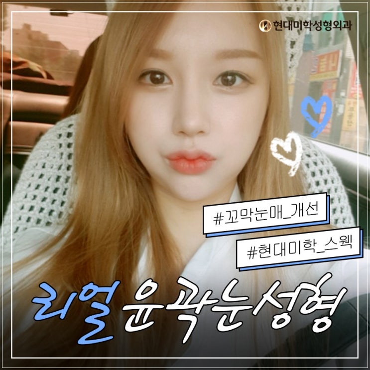 쌍꺼풀눈매교정 또렷또렷