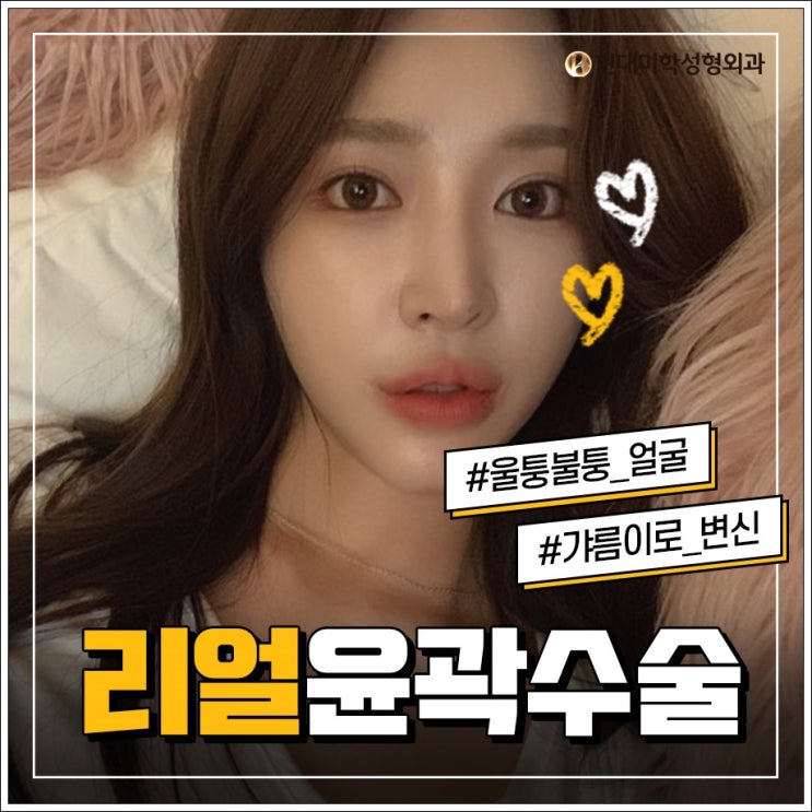 아래턱수술 트렌드에 맞게