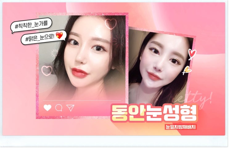 눈밑지방재배치비용 궁금했었어요.