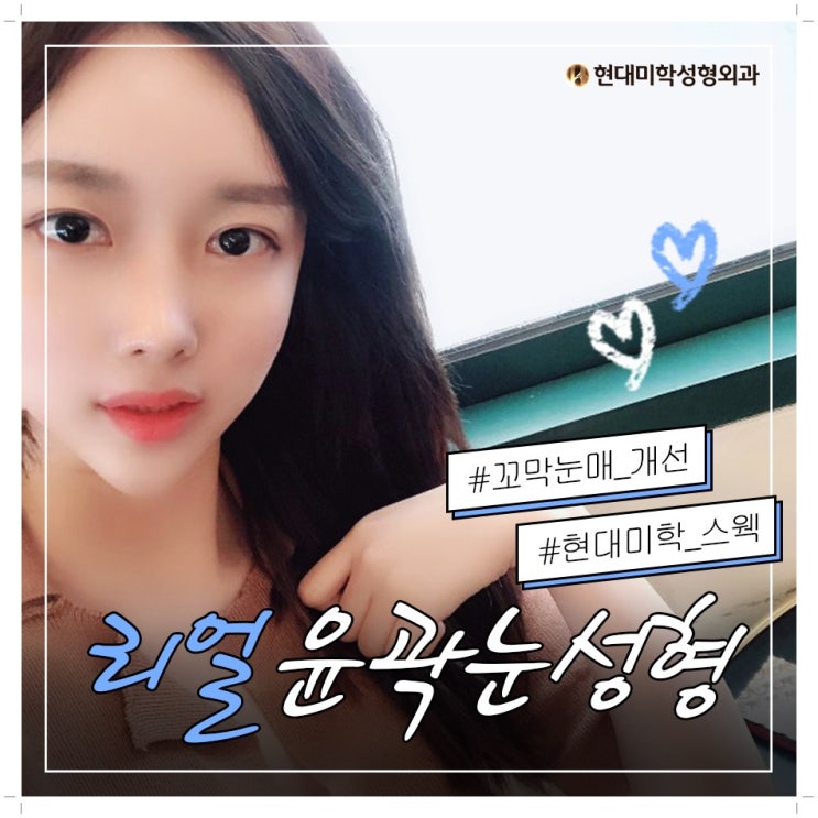 눈수술비용 예쁘게 완성