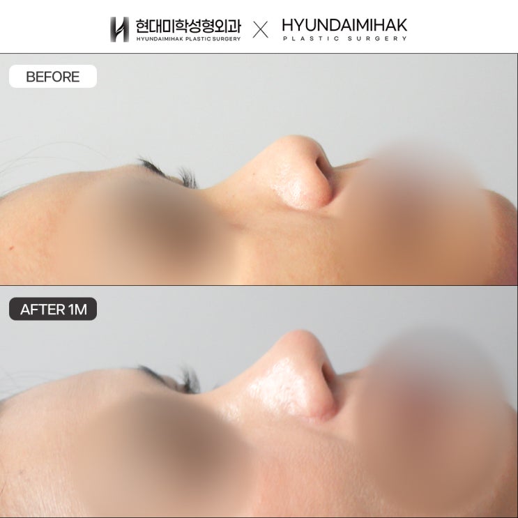 복코수술가격을 결정짓는 요인들은 무엇일까