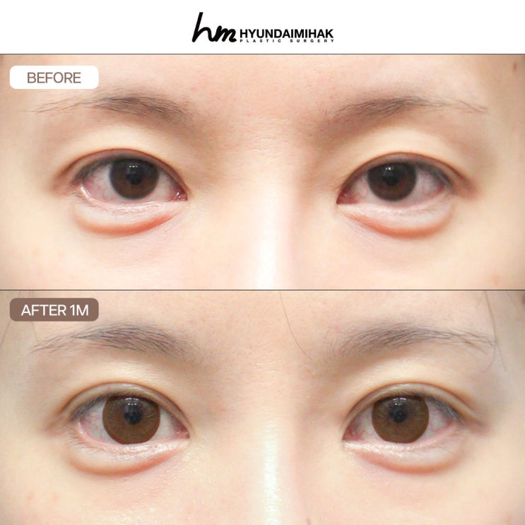 눈성형재수술 실패한 눈을 바로잡는 기술력