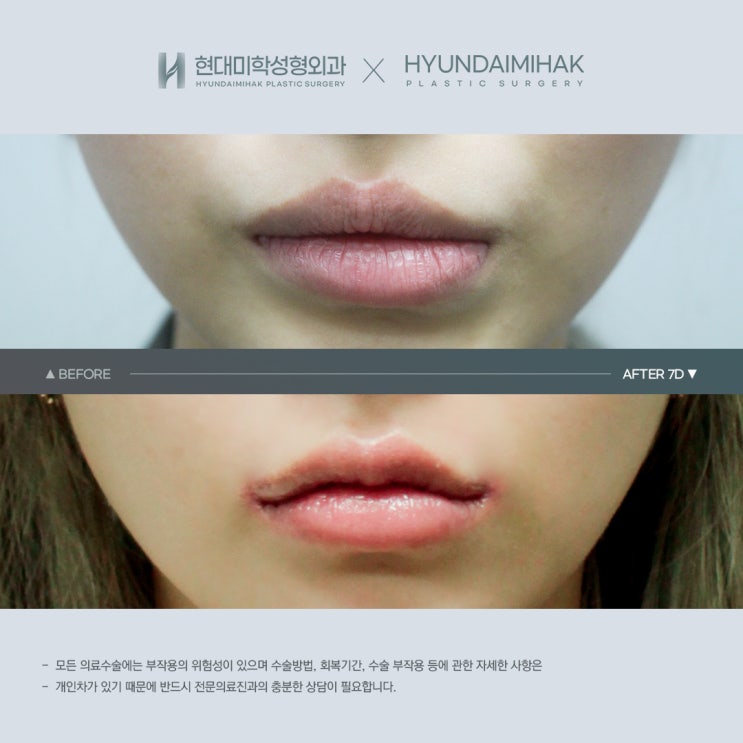 큐피드라인 성형으로 또렷한 볼륨 입술 완성하기
