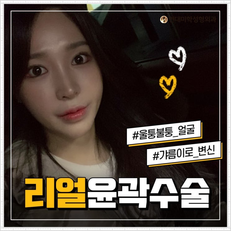 옆광대축소 이미지대변신
