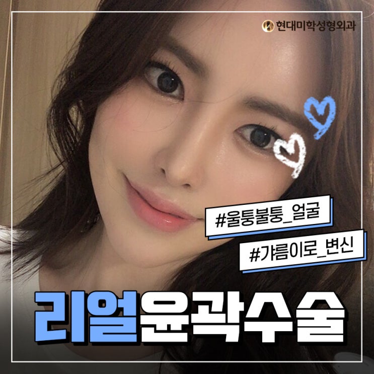 광대뼈축소술후기 놀라지 말아요
