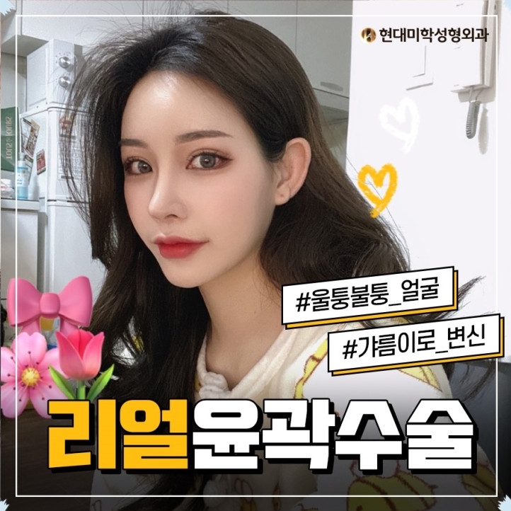 안면윤곽수술비용 자꾸만 거울봐요