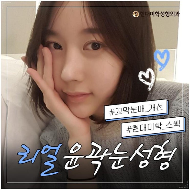 앞트임수술 예쁘게 트이네