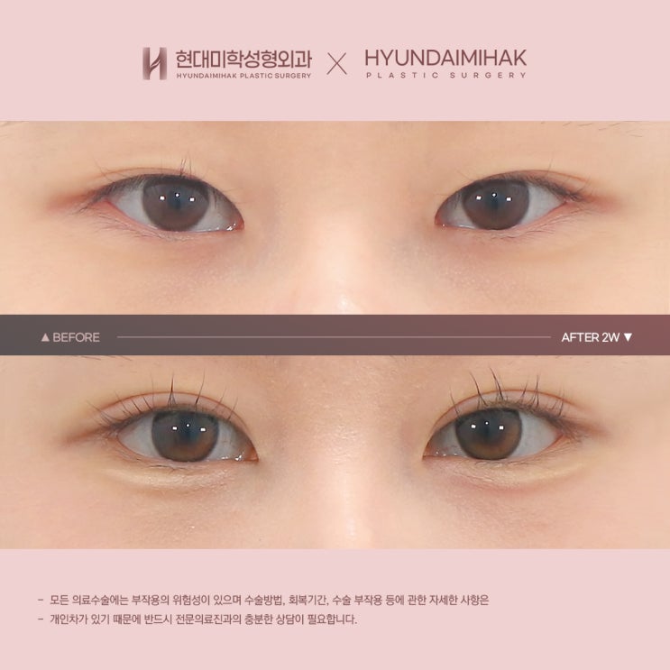 매몰쌍수가격 참고하며 눈매 자연스럽게 가꾸기