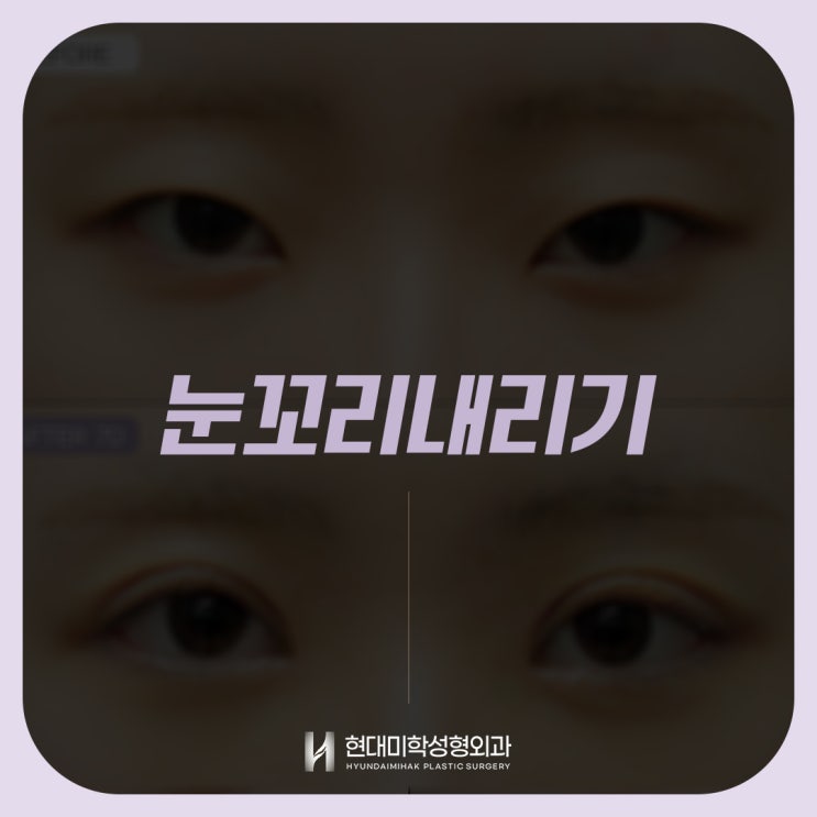 눈꼬리내리는 수술로 첫인상 바꾸고 강아지상얼굴 만들기