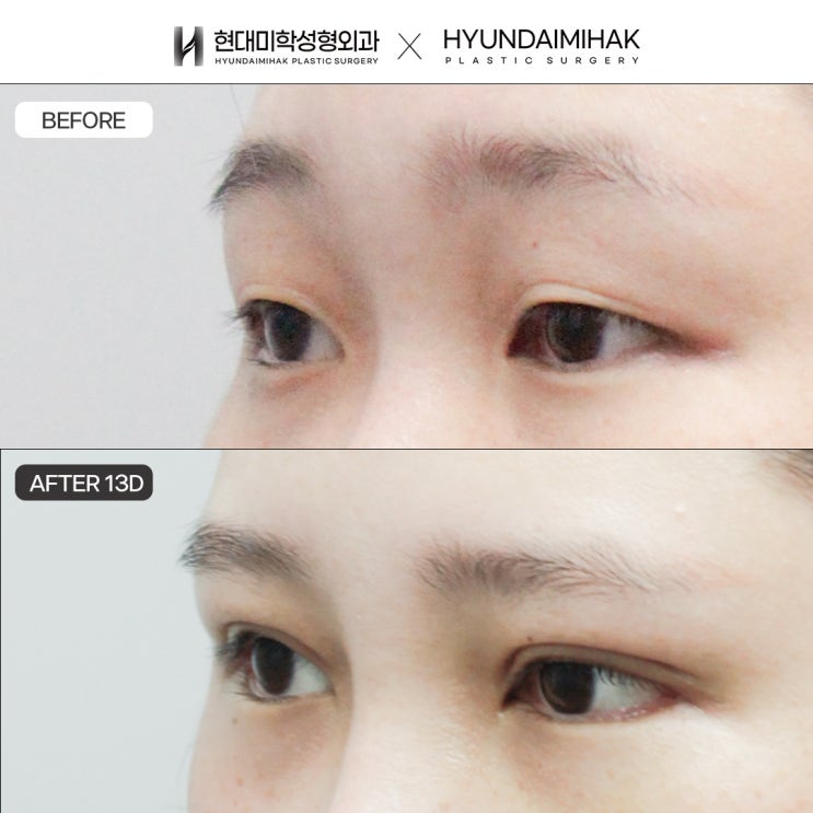 절개눈매교정전후 또렷하고 자연스러운 눈매 변화