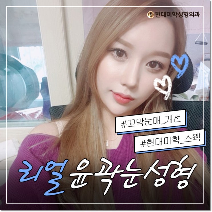 뒤트임밑트임후기 쩔어요쩔어
