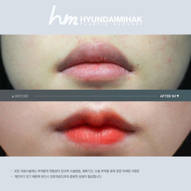 입술성형비용 예뻐지는 가장 현실적인 선택