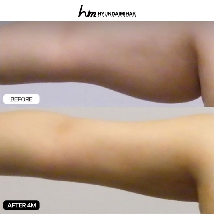 팔뚝지방흡입수술 반드시 알아야 할 체크리스트
