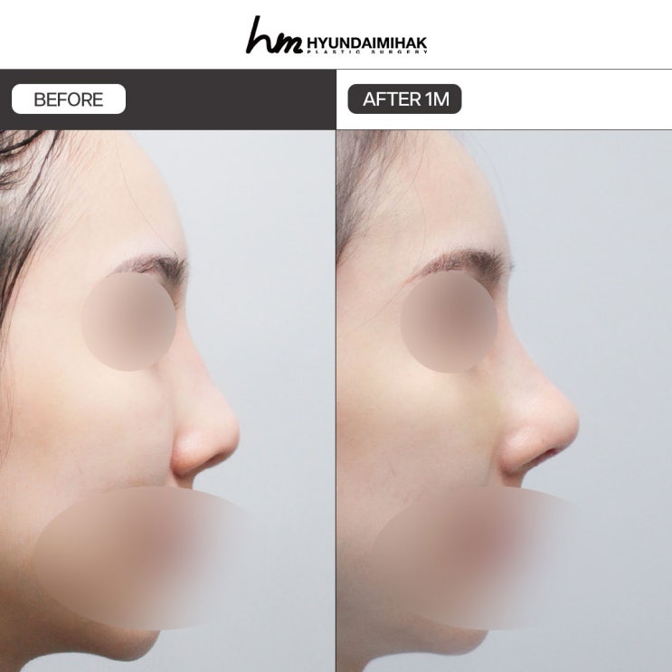 강남코재수술 실패 원인 발견부터 해결책 제시까지