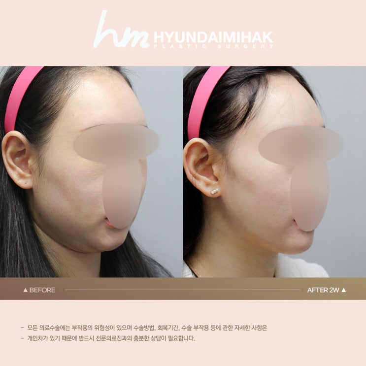 늘어진턱살 다이어트로도 안 될 때 해결책은
