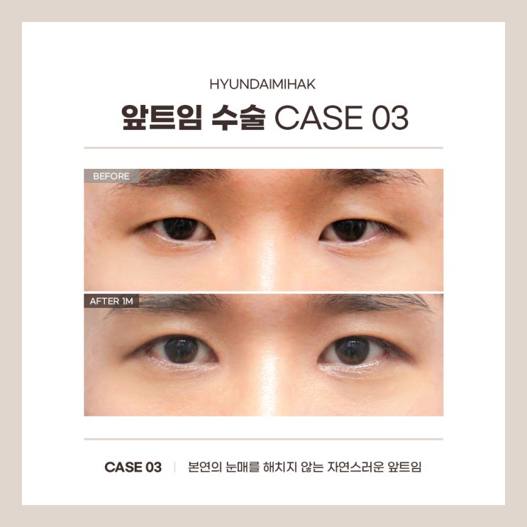 강남앞트임 몽고주름 개선 부작용 극복 수술효과 극대화