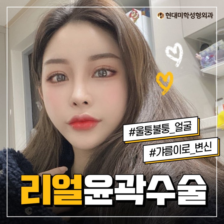 안면윤곽가격 예쁨미뿜뿜