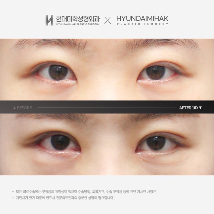 자연유착수술전후 잘하는 곳을 찾는다면