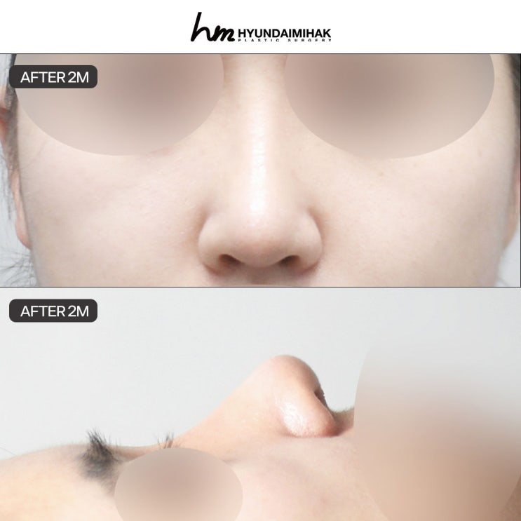 자려한코성형 자연스러움과 또렷함 사이의 솔루션