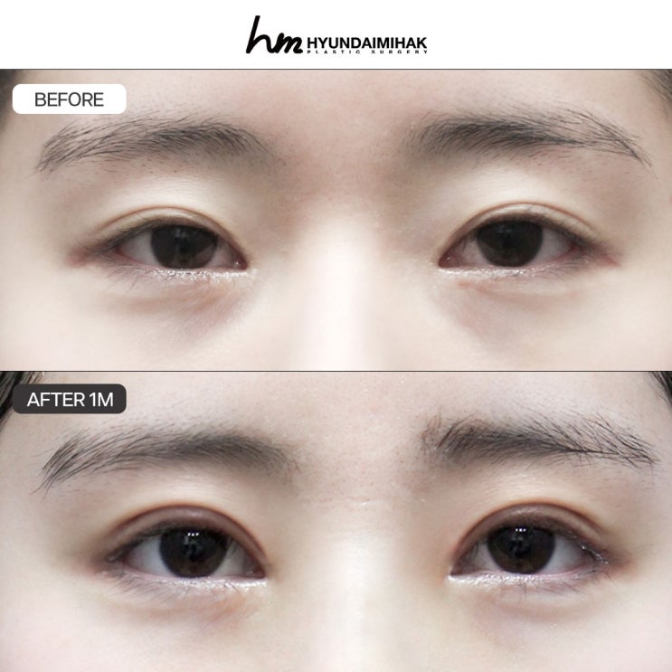 이럴 땐 이런 수술, 당신에게 필요한 맞춤 성형 이야기