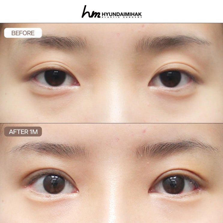 성형외과 상담 방문할 때 체크리스트 : 눈, 코, 실리프팅, 지방흡입 편
