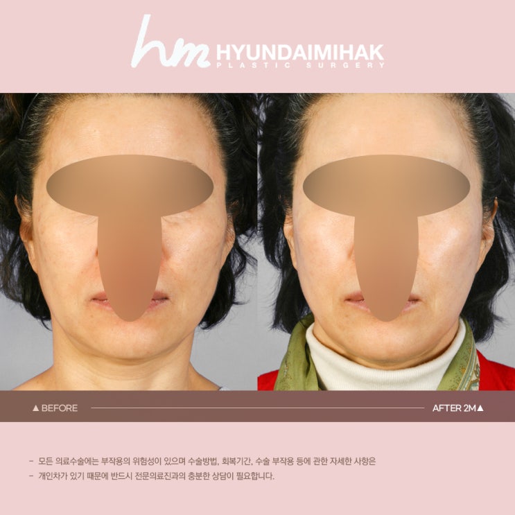 안면거상 리프팅 확실한 변화 원한다면｜SMAS층 리프팅 효과·회복·유지기간 정리