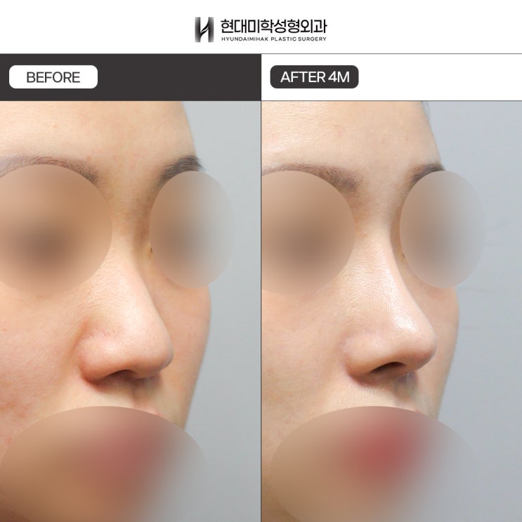 직반코성형, 자연스럽고 세련된 변화를 위한 낮은코 성형
