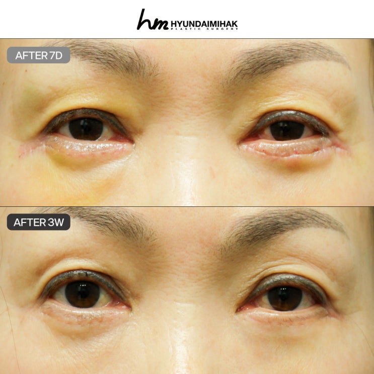 하안검 수술 흉터 없는 자연스러운 결과를 원한다면