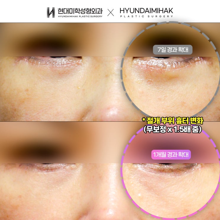 하안검수술잘하는곳 회춘하는 비법